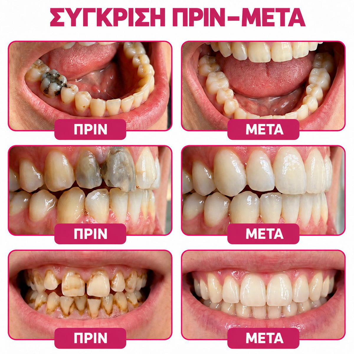 🧚‍♀️☘️🦷HEATWOLF® DenPerm – Φυσική γέλη πλήρωσης σμάλτου για την αποκατάσταση της τερηδόνας